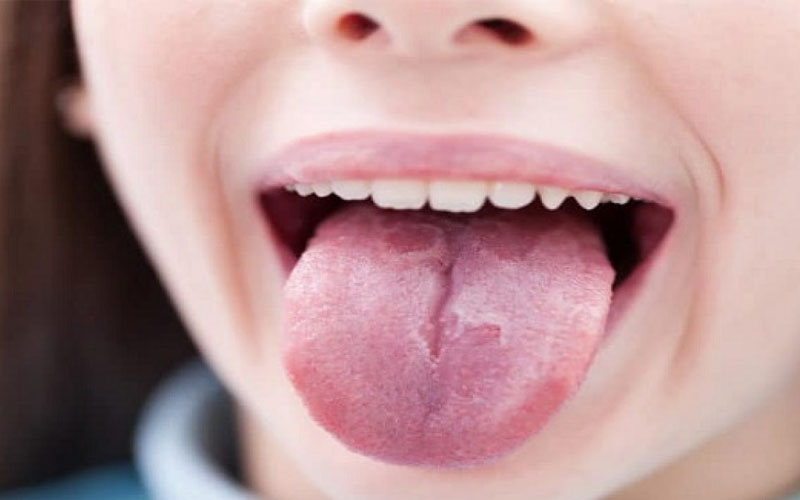 Triệu chứng nấm lưỡi bản đồ ở trẻ nhỏ