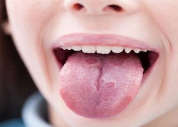 [Tìm Hiểu] Bệnh Nấm Lưỡi Bản Đồ Là Gì? Triệu Chứng Và Cách Chữa