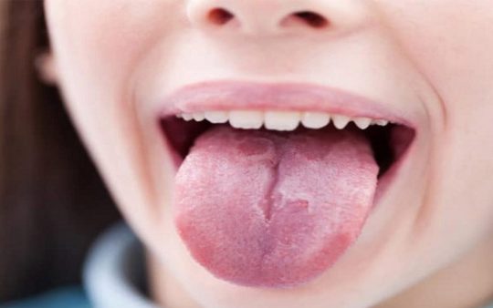 [Tìm Hiểu] Bệnh Nấm Lưỡi Bản Đồ Là Gì? Triệu Chứng Và Cách Chữa