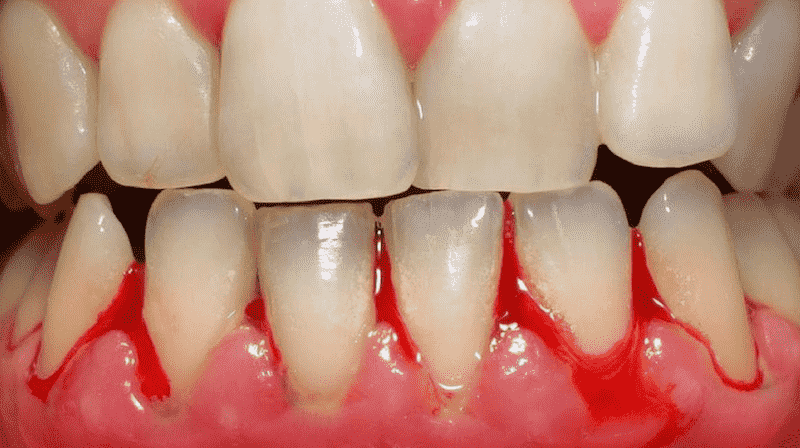 Viêm lợi nói chung là tình trạng tổn thương vùng nướu răng