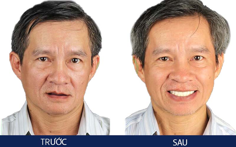 Hình ảnh chú Sơn trước và sau khi trồng răng Implant tại Videntlal