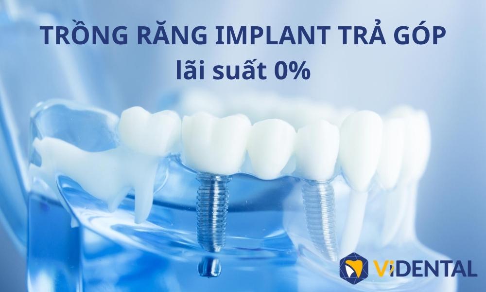 Trồng răng Implant trả góp 0đ tại Viện nha khoa ViDental