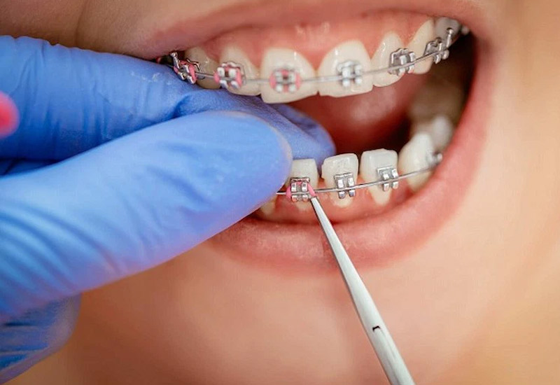 Lấy cao răng là phương pháp điều trị mang lại hiệu quả cao