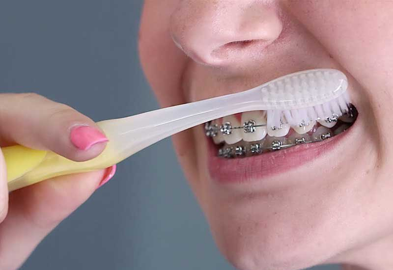 Trong quá trình niềng răng, cần chú ý vệ sinh răng miệng đều đặn mỗi ngày