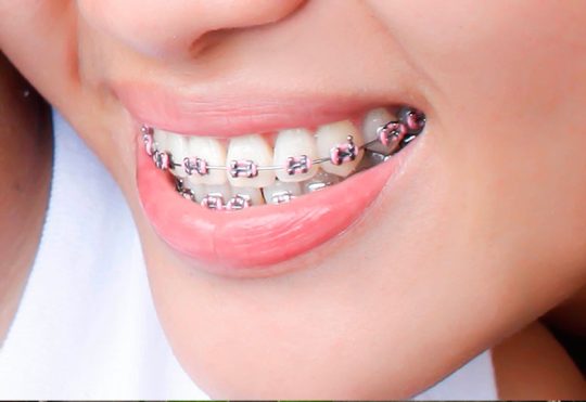 Viêm nha chu khi niềng răng là tình trạng khá phổ biến