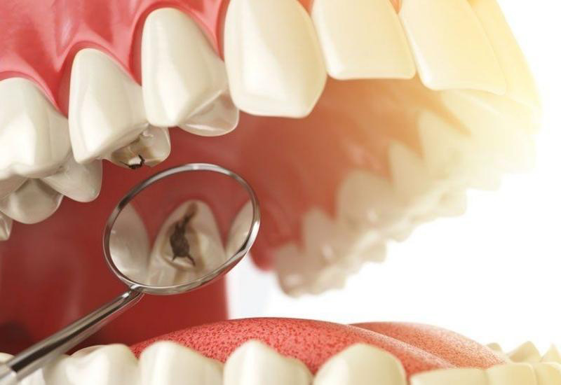 Nên thường xuyên vệ sinh răng miệng chân răng và lỗ sâu răng