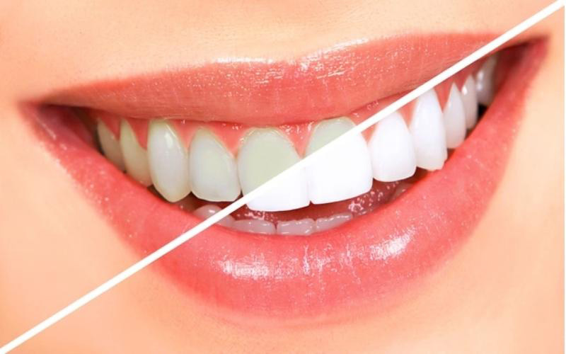 Tẩy trắng răng giúp trị hôi miệng hiệu quả