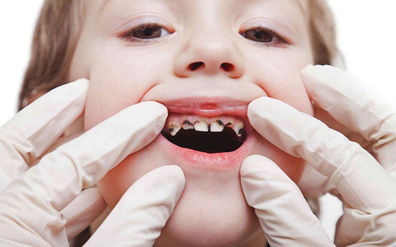 Sâu răng là một trong những nguyên nhân phổ biến gây hôi miệng ở trẻ