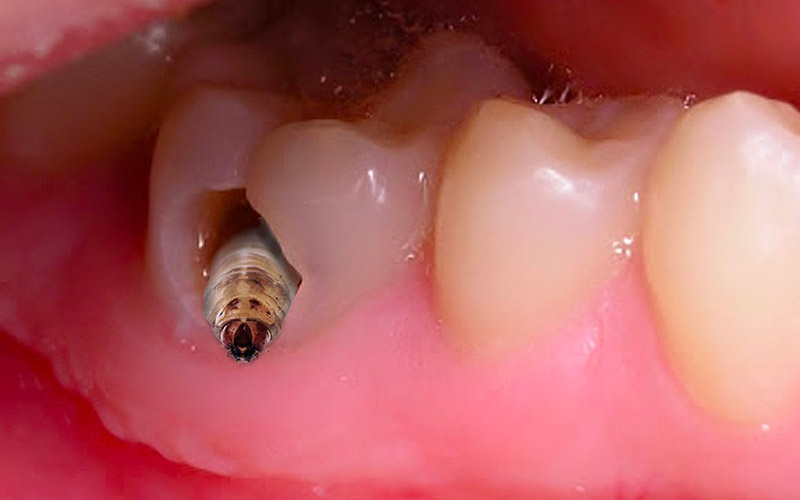 Lỗ sâu răng là nơi vi khuẩn trú ngụ, xâm nhập