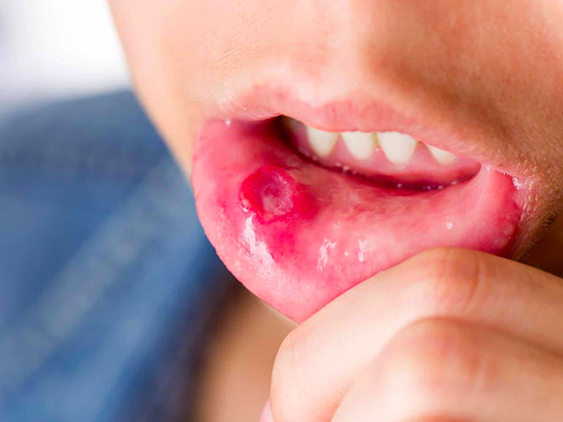 Nhiệt miệng là bệnh lý gây ra nhiều sự phiền toái cho cuộc sống của người mắc