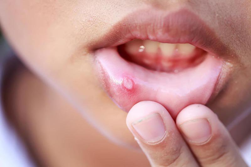 Nhiệt miệng An Thảo giúp giảm sưng và làm lành vết loét ở miệng