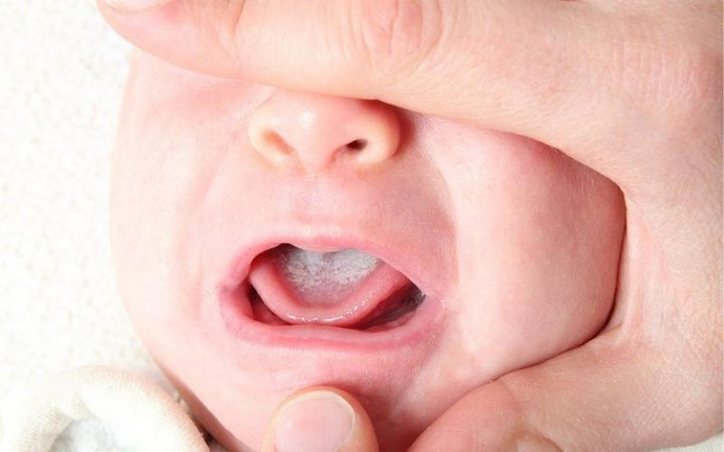 Tình trạng nấm lưỡi ở trẻ sơ sinh
