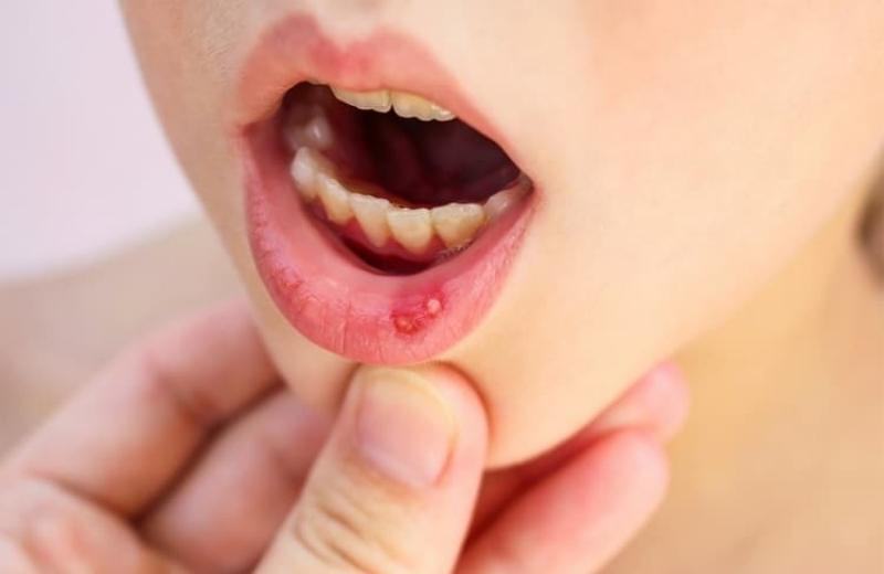 Mouthpaste hỗ trợ điều trị tình trạng nhiệt miệng, viêm loét miệng hiệu quả