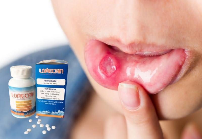 Thuốc nhiệt miệng Bạch Mai còn có tên gọi khác là Lomecain