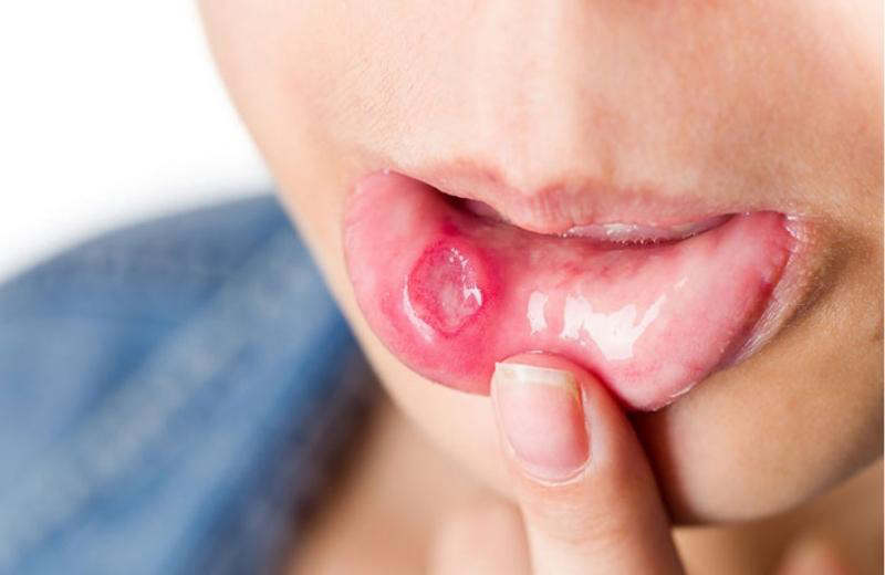 Nhiệt miệng Tametop phù hợp với người đang gặp các bệnh lý về niêm mạc miệng