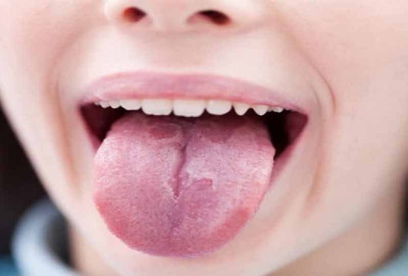 Lưỡi bị nấm xuất hiện các cụm trắng trên bề mặt lưỡi hoặc xung quanh khoang miệng