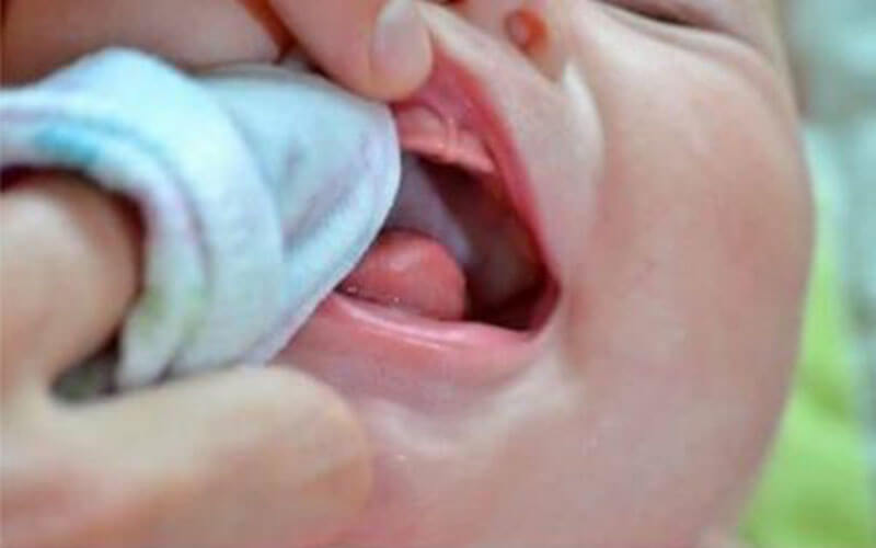 Thực hiện tưa lưỡi trước khi cho bé bú để tránh ọc sữa