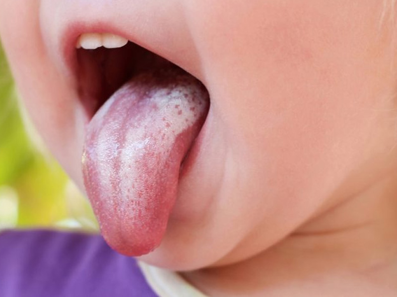 Nấm lưỡi ảnh hưởng nhiều đến sinh hoạt và ăn uống hàng ngày 