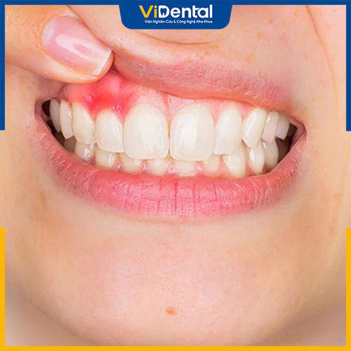 Bé bị nhiệt miệng chảy máu chân răng có thể xuất phát từ nhiều nguyên nhân