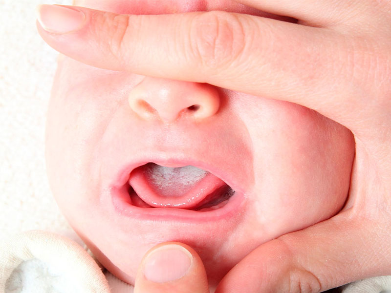 Tình trạng nấm lưỡi nhẹ ở trẻ