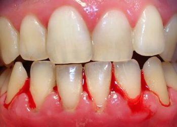 Vệ sinh răng miệng chưa đúng là nguyên nhân gây ra chảy máu chân răng hàm
