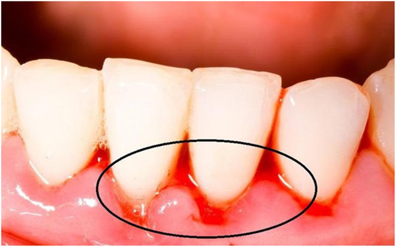Dùng bàn chảy đánh răng quá cứng có thể gây chảy máu chân răng hàm