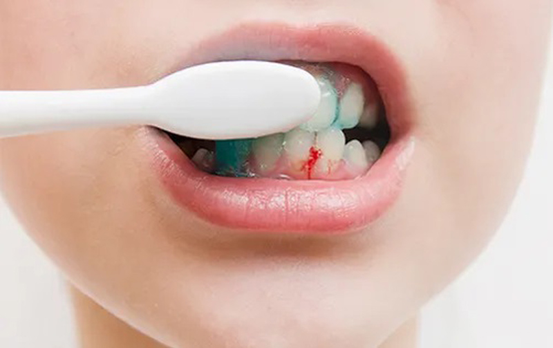 Có nhiều nguyên nhân gây nên chảy máu chân răng khi đánh răng