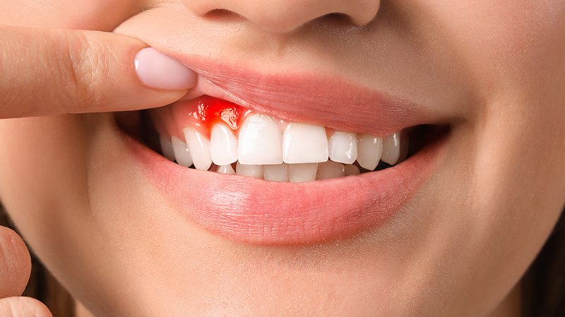 Có nhiều nguyên nhân gây chảy máu chân răng trong giai đoạn mang thai