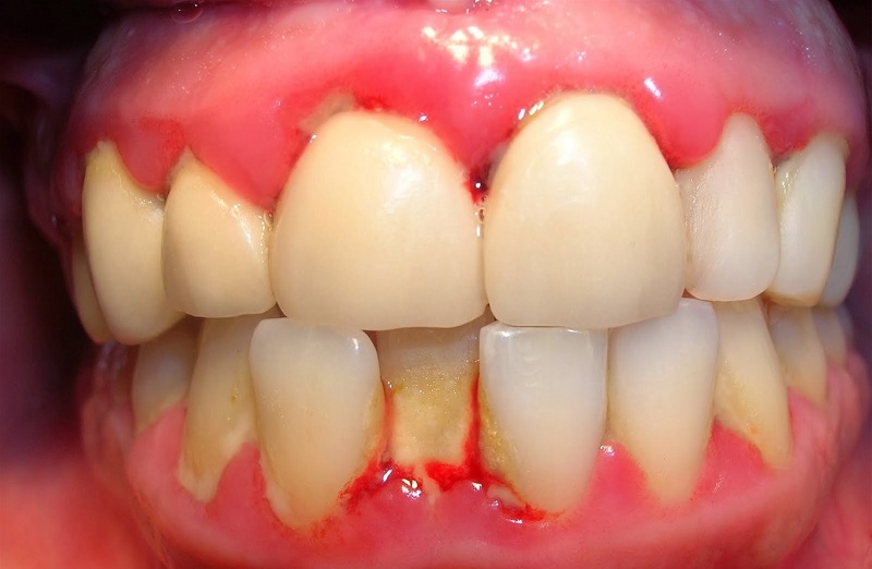 Mảng bám tích tụ nhiều trên răng gây bệnh lý và chảy máu chân răng