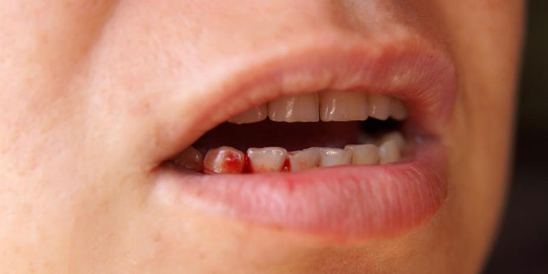 Nhiều bệnh lý sức khỏe đi kèm triệu chứng chảy máu chân răng