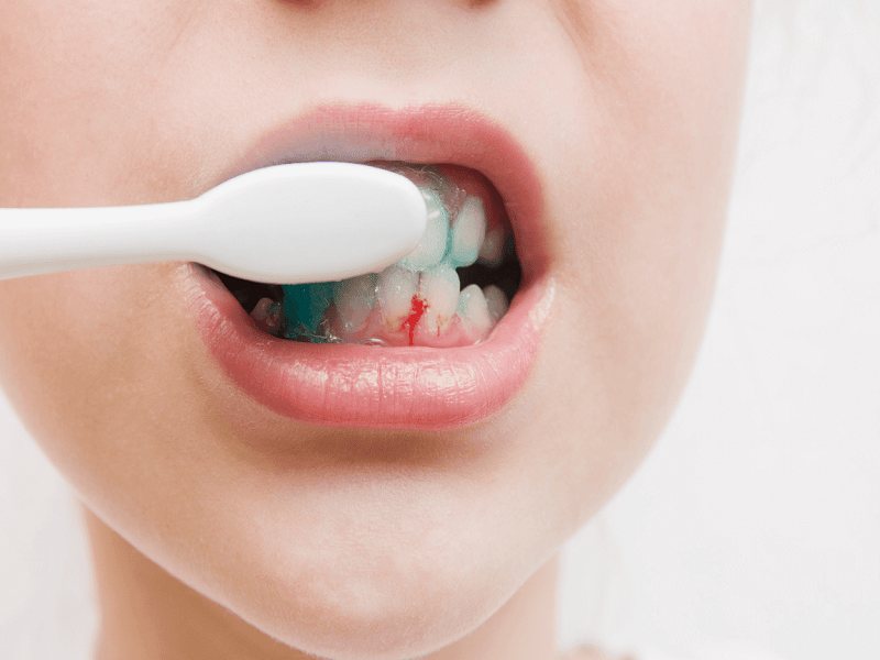 Thói quen sinh hoạt hàng ngày có thể dẫn đến chảy máu chân răng không ngừng