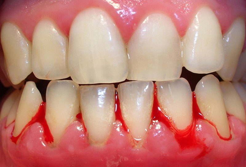 Chảy máu chân răng không ngừng do bệnh lý có thể ảnh hưởng đến tính mạng