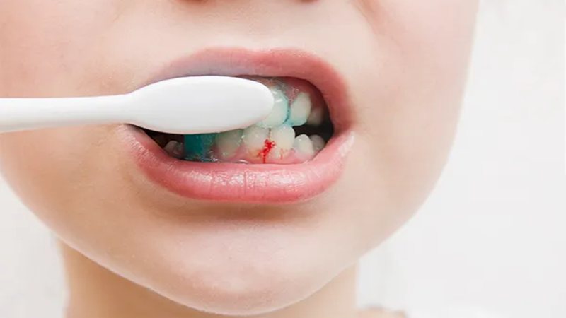 Chải răng sai cách là một trong những nguyên nhân gây bệnh