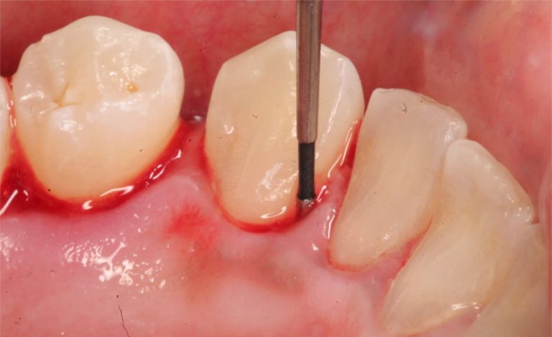 Chảy máu chân răng ở trẻ em kéo dài gây nên viêm nha chu