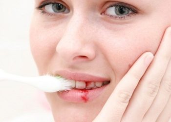 Chảy máu chân răng sưng lợi là bệnh lý thường gặp