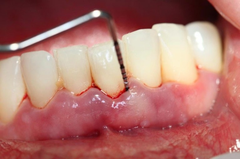 Vệ sinh răng miệng không đúng cách là một trong những nguyên nhân gây chảy máu chân răng sưng lợi