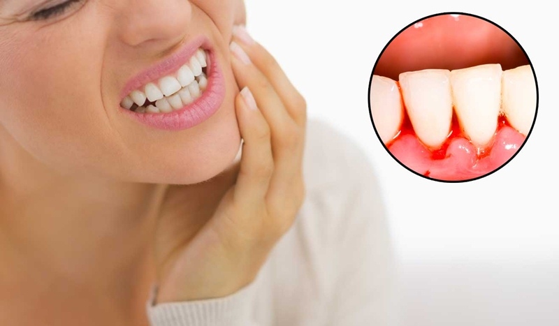 Chảy máu chân răng liên tục có thể gây viêm nha chu, sưng lợi, sâu răng