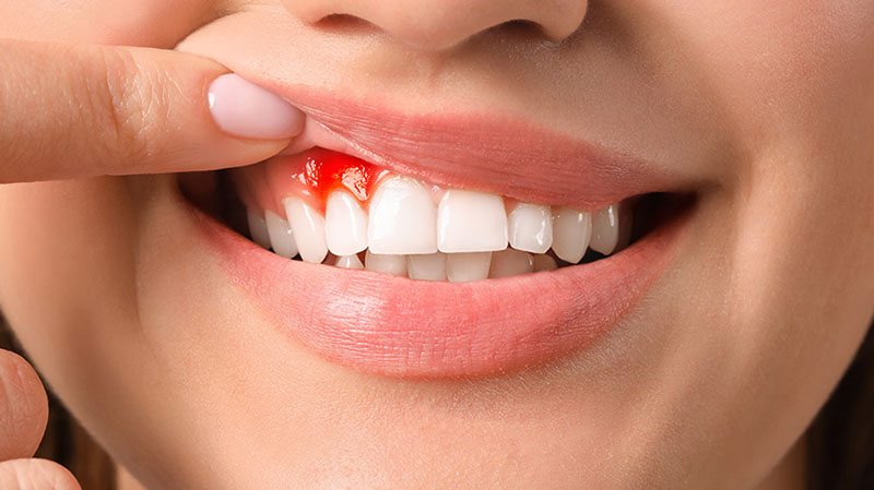Chảy máu chân răng có thể là dấu hiệu của các bệnh răng miệng