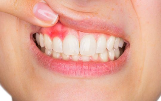 Chảy máu nướu răng xuất hiện khi răng miệng hoặc sức khỏe gặp vấn đề
