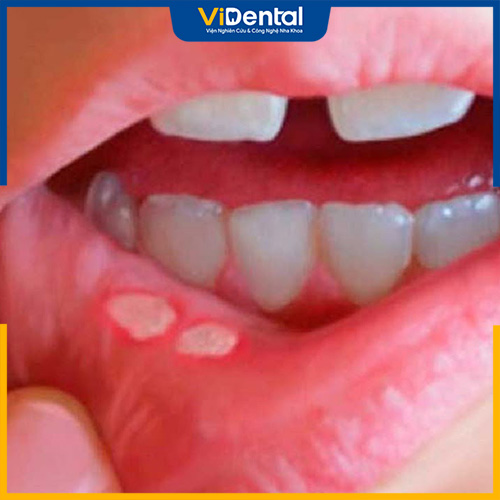 Nhiệt miệng là bệnh lý xuất hiện khi trẻ ăn nhiều đồ cay nóng