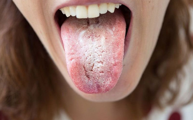 Tổn thương màu trắng kem ở miệng gây ra bởi nấm Candida