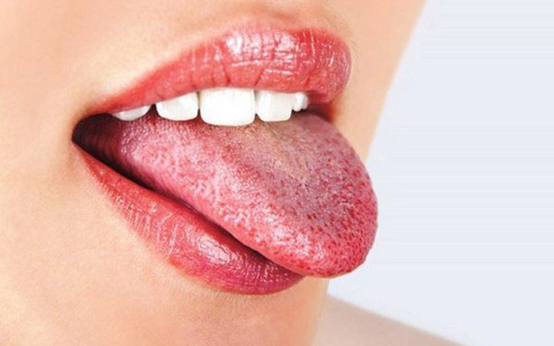 Hình ảnh nấm Candida ở miệng gây sưng tấy và khó chịu cho lưỡi