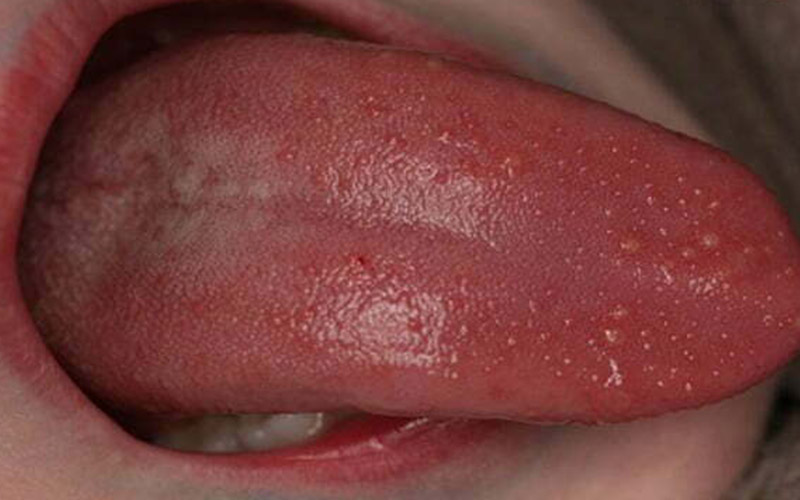 Lưỡi bị nhiễm nấm Candida gây chảy máu