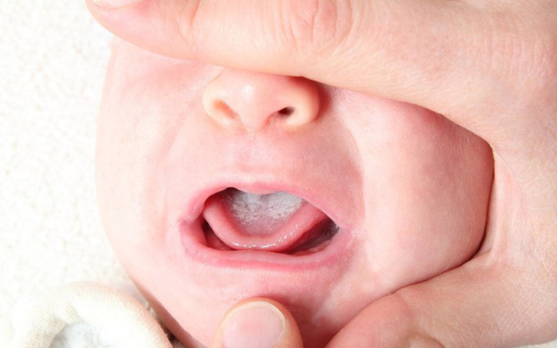 Nấm Candida ở trẻ sơ sinh khiến nhiều phụ huynh lo lắng