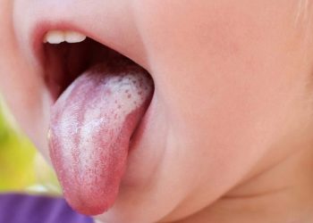 [Giải Đáp Từ Chuyên Gia] Nấm Lưỡi Có Sốt Không?