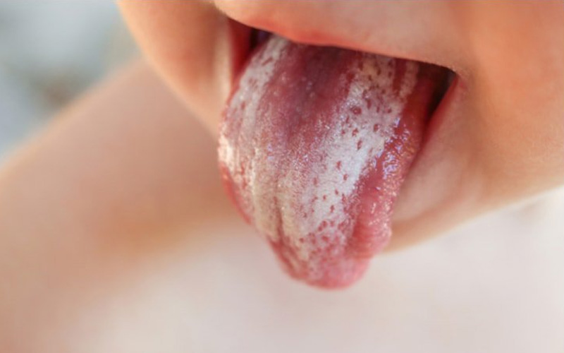 Bị rối loạn hệ tiêu hóa là 1 trong những nguyên nhân gây nấm lưỡi