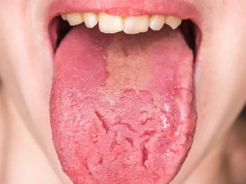Dấu hiệu nhận biết nấm lưỡi gây hôi miệng