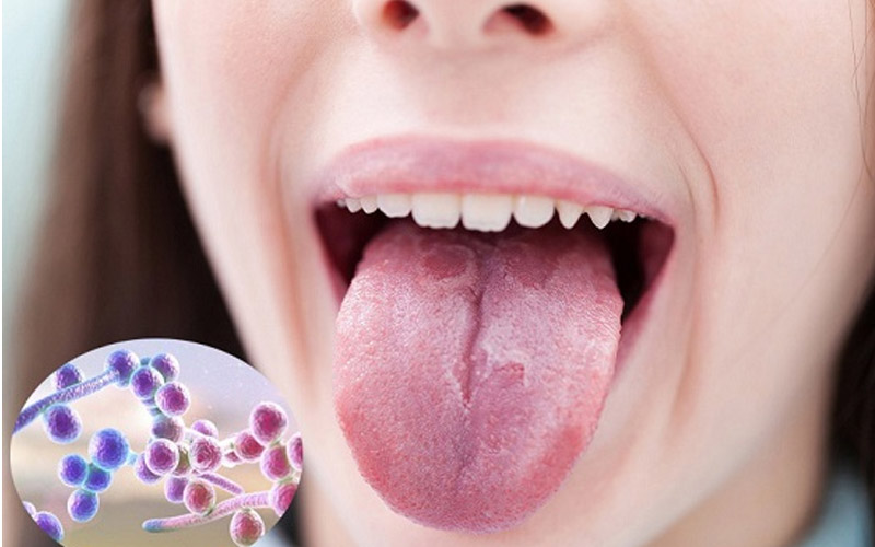 Nguyên nhân gây nấm lưỡi ở người nhiễm HIV