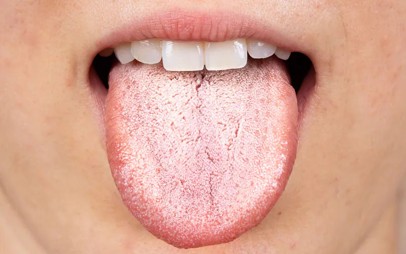 Khoang miệng khô, nứt nẻ là biểu hiện của nấm lưỡi hiv 