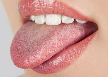 Nấm Lưỡi Hiv: Nguyên nhân, cách chữa và một số lưu ý trong điều trị